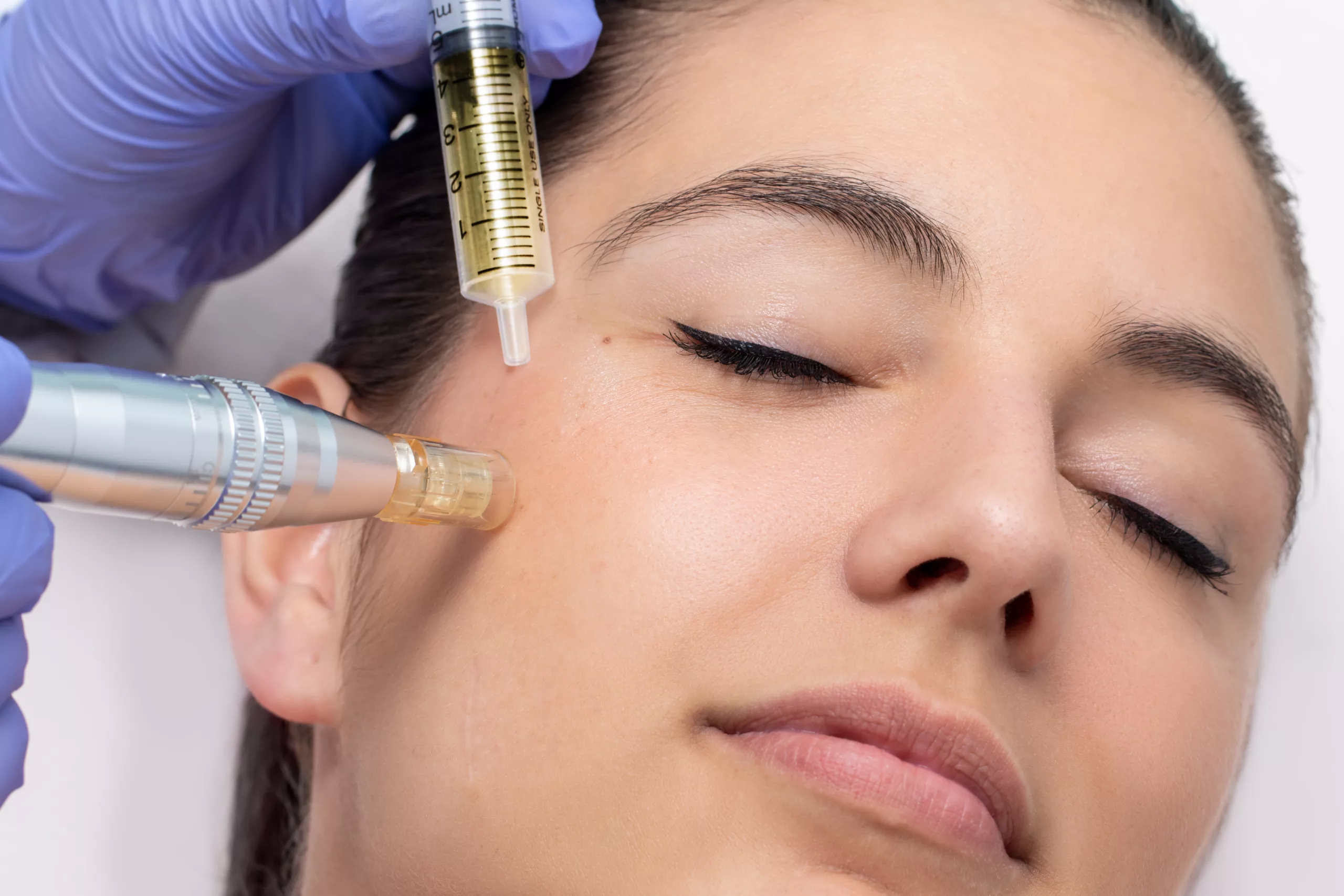 What is Microneedling: Types, Cost, and FAQs