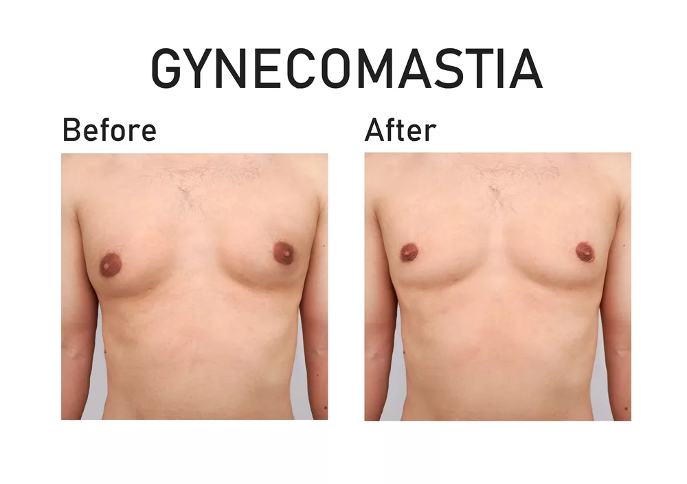 How Does Male Breast Reduction Work?