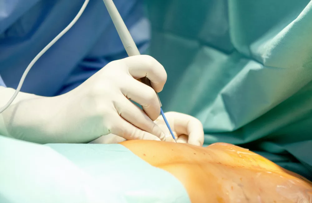 Gynecomastia Surgery at DrSkin Med Spa