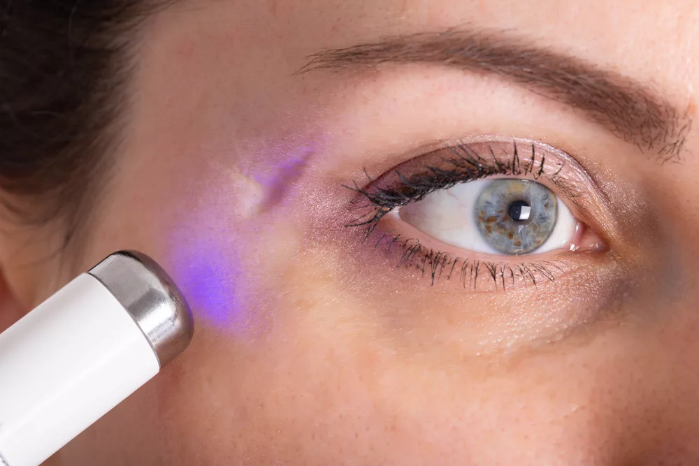 1. Laser Scar Removal: Transformative Skin Renewal