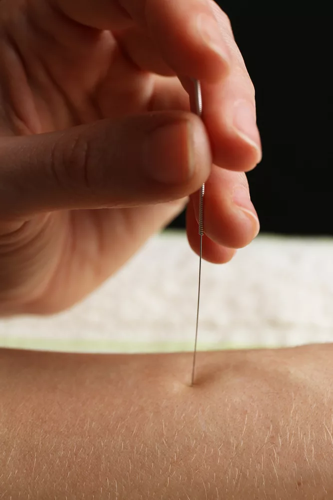 Experience the Healing Power of Acupuncture Today