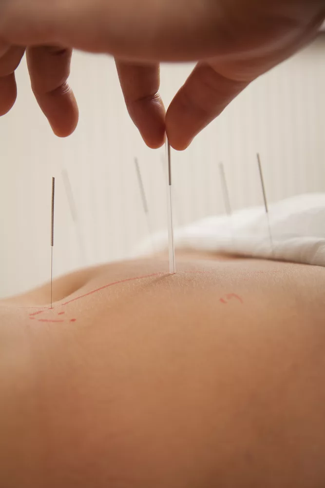 What Happens During an Acupuncture Session?