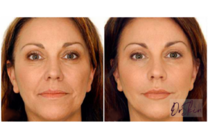 thread face lift before and after