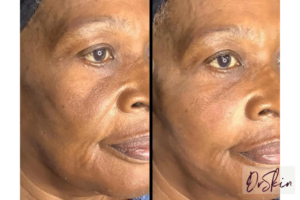 thread face lift before and after