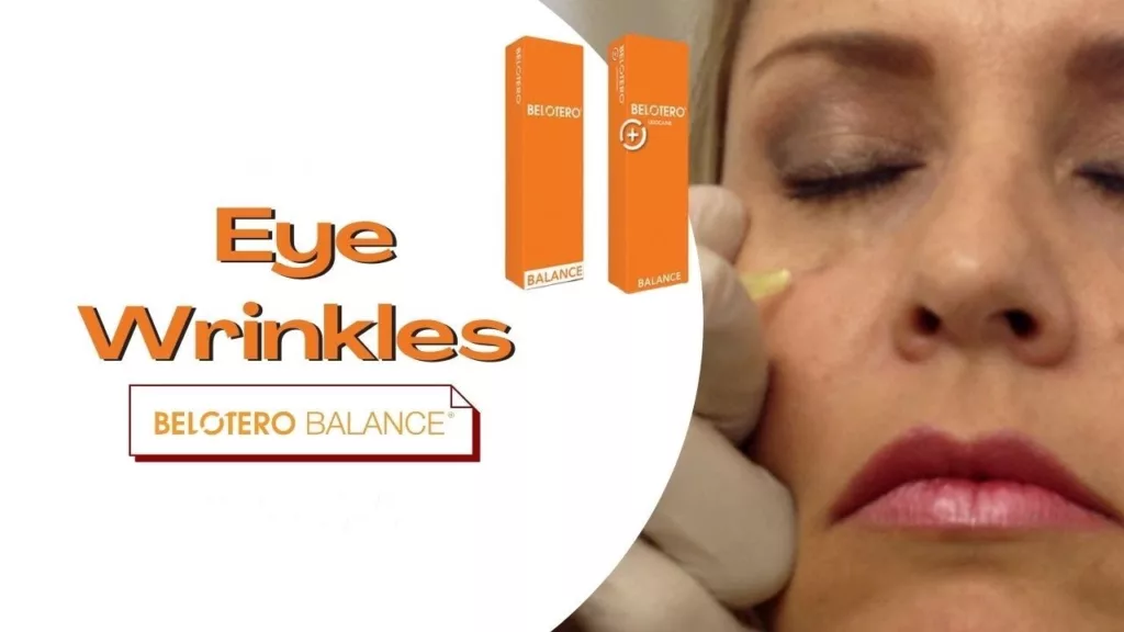 Belotero Balance - EYE WRINKLES + ACTUAL PATIENT ABOUT TO RECEIVE TREATMENT