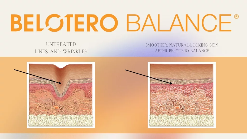 Belotero Balance - HOW IT WORKS ON WRINKLES (NICE CLINIAL PERSPECTIVE)
