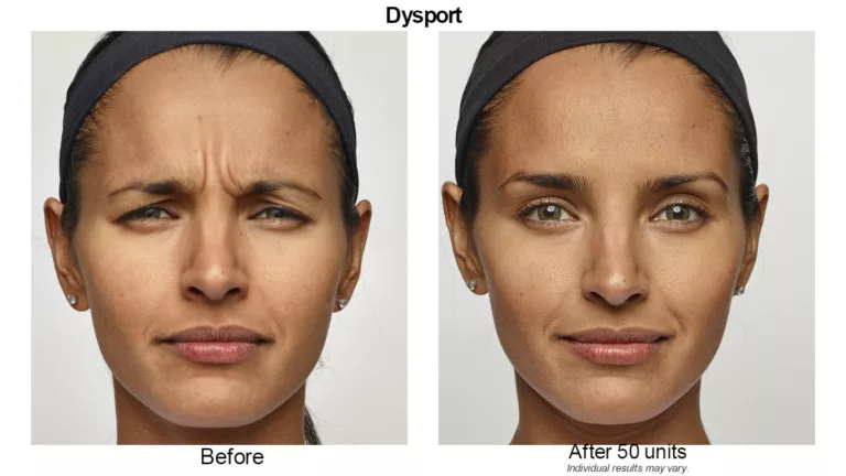 Dysport - BEFORE + AFTER COMPANY PIC #3