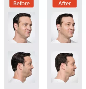 Kybella - BEFORE + AFTER #2