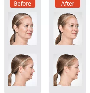 Kybella - BEFORE + AFTER #3