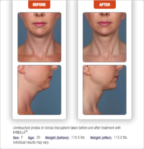 Kybella - BEFORE + AFTER #4