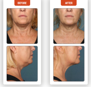 Kybella - BEFORE + AFTER #5