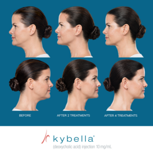 Kybella - BEFORE + AFTER PROGRESSION #10