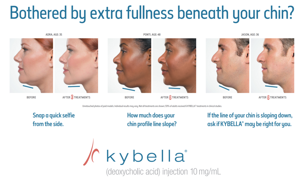 Kybella - BEFORE + AFTER PROGRESSION #3 + AD