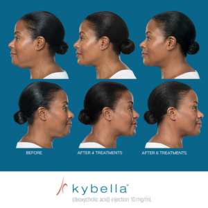Kybella - BEFORE + AFTER PROGRESSION #8