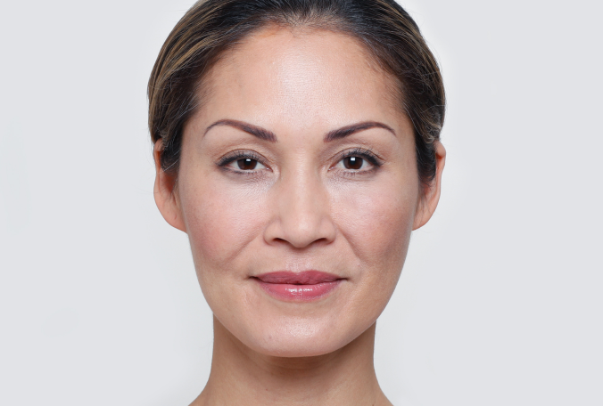 Gina was treated with 0.5 mL Restylane® Lyft in each cheek, and 1 mL Restylane® Lyft in each nasolabial fold.