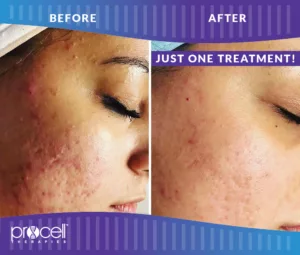 Procell - ACNE SCARS BEFORE + AFTER #2