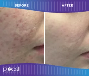 Procell - ACNE SCARS BEFORE + AFTER #3