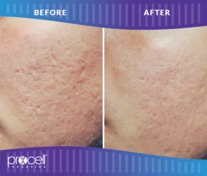 Procell - ACNE SCARS BEFORE + AFTER