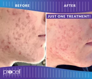 Procell - ACTIVE ACNE BEFORE + AFTER
