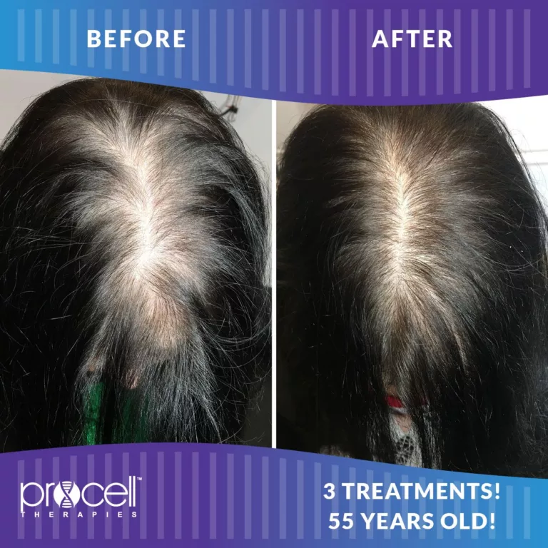 Procell - HAIR REGROWTH BEFORE + AFTER