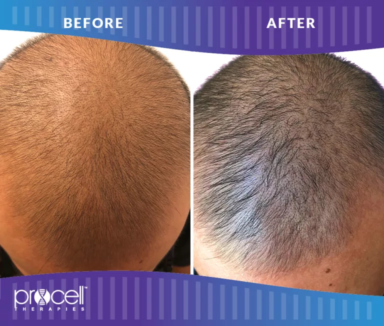 Procell - HAIR RESTORATION BEFORE + AFTER #2