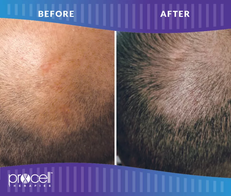 Procell - HAIR RESTORATION BEFORE + AFTER #3