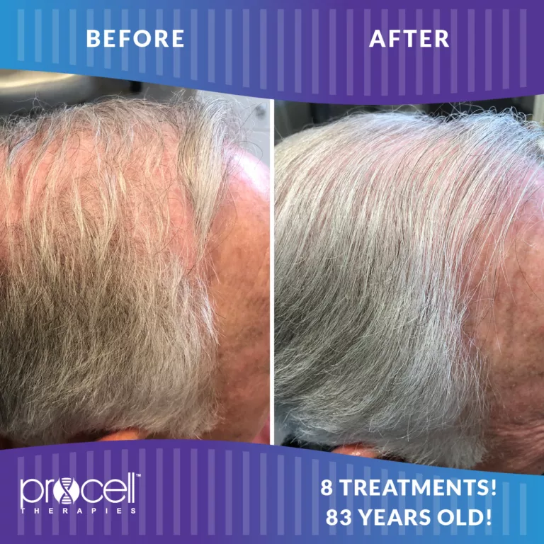 Procell - HAIR RESTORATION BEFORE + AFTER #4