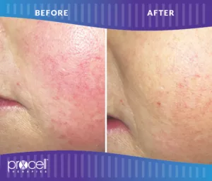Procell - ROSACEA BEFORE + AFTER