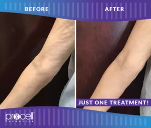 Procell - SKIN TIGHTENING ARMS
