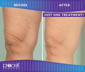 Procell - SKIN TIGHTENING BEFORE + AFTER #3
