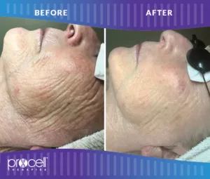 Procell - SKIN TIGHTENING + SPIDER VEINS BEFORE + AFTER
