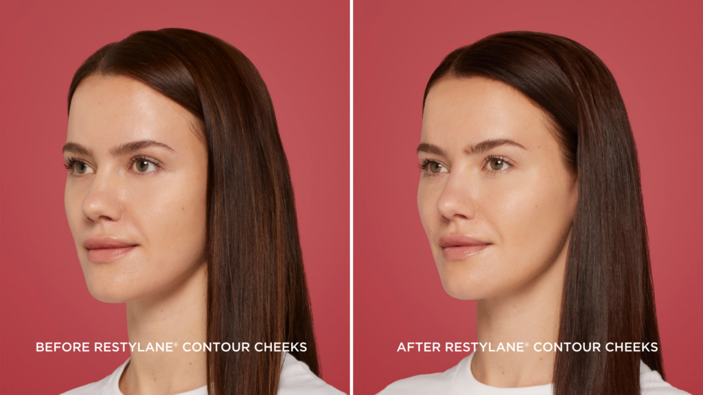 Restylane Contour - BEFORE + AFTER 2