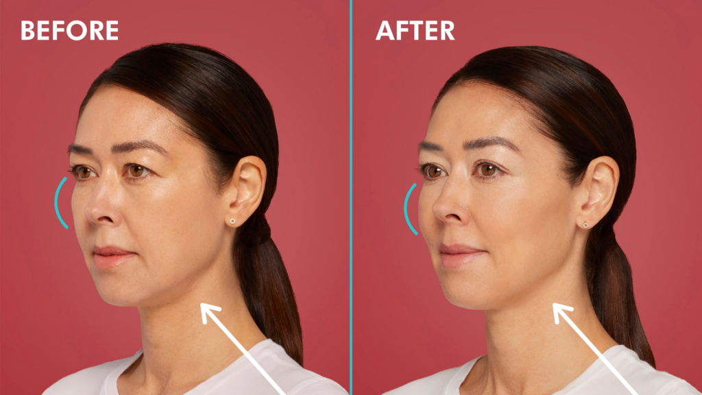Restylane Contour - BEFORE + AFTER 4