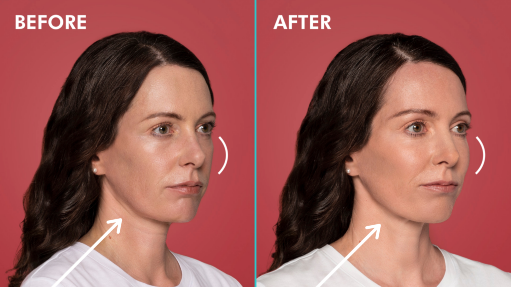 Restylane Contour - BEFORE + AFTER 5