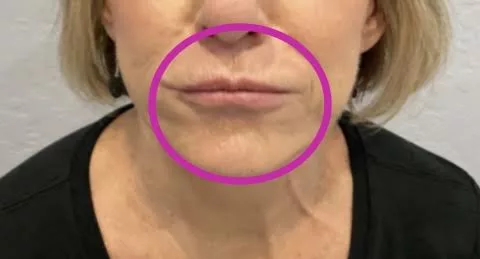 Toxin + Filler Injections - BEFORE LIP LINES