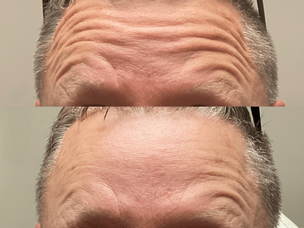 Toxin Injections - BEFORE + AFTER FOREHEAD #2