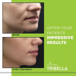 Tribella - 3 TREATMENTS BEFORE + AFTER