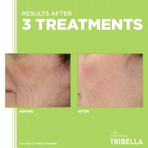 Tribella - 3 TREATMENTS BEFORE + AFTER #4
