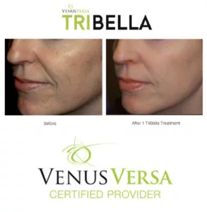 Tribella - BEFORE + AFTER + CERTIFIED PROVIDER