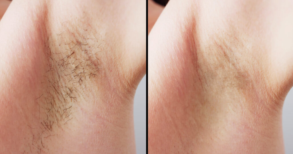 Laser Hair Removal Before and After 2024