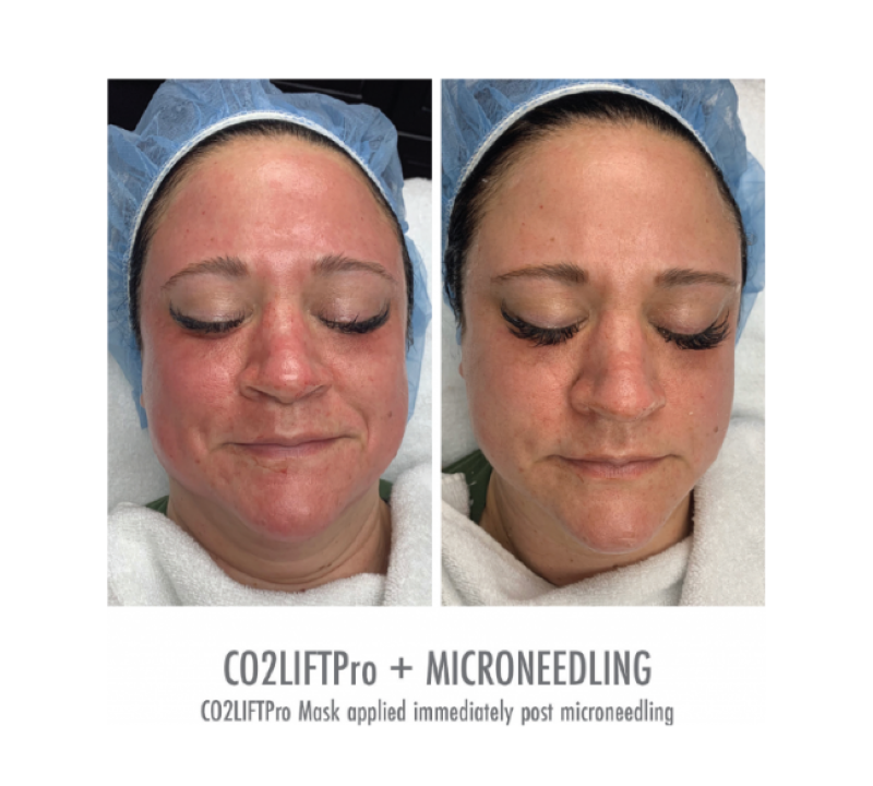 Before and After Image 1 DrSkin CO2 Lift