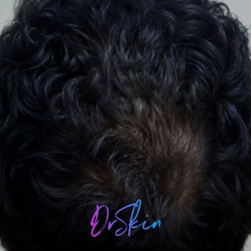 Hair Restoration Carousel 1.2