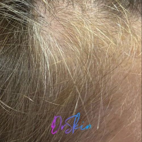 Hair Restoration Carousel 2.1