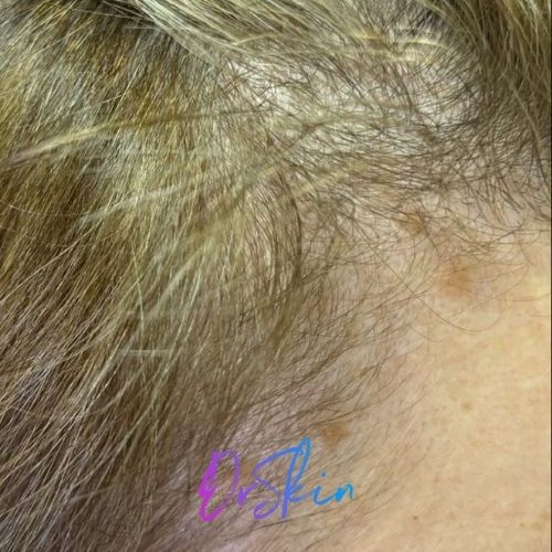 Hair Restoration Carousel 2.2