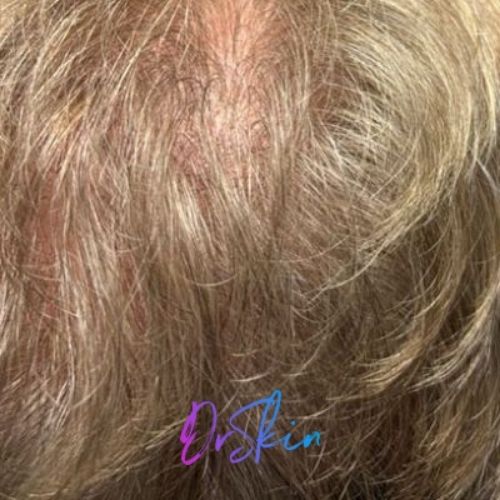 Hair Restoration Carousel 3.1