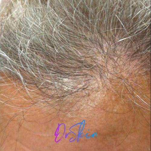 Hair Restoration Carousel 4.2