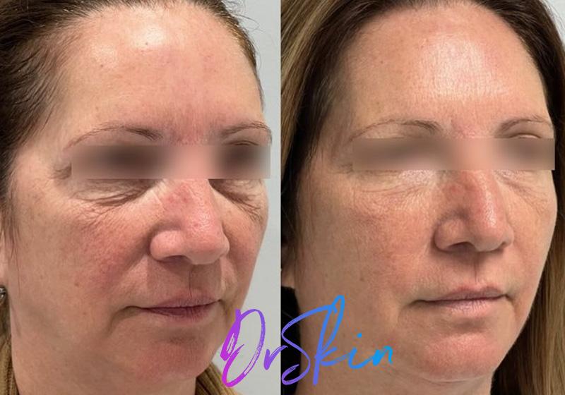 UltraClear-BA-1-TREATMENT-