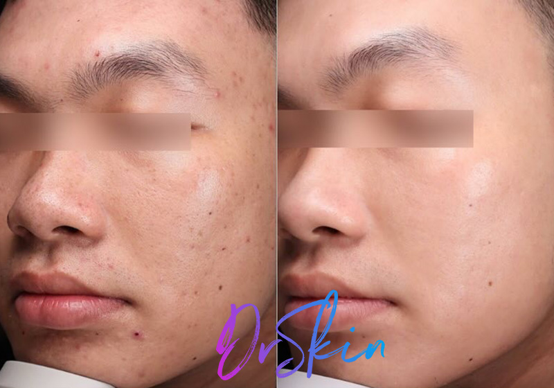 UltraClear-BA-1-TREATMENT-1-MO-POST