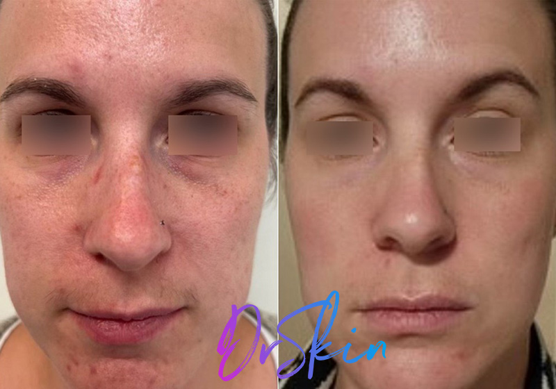 UltraClear-BA-1-TREATMENT-1-WK-POST