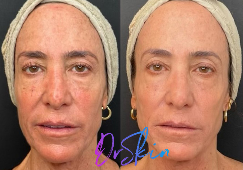 UltraClear-BA-1-TREATMENT-2